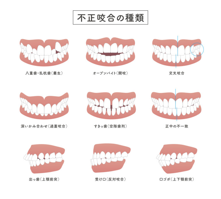 不正咬合の種類